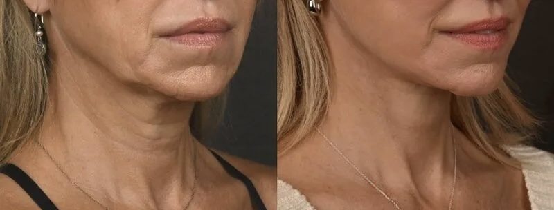 Skin texture & age spots — before and after